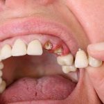 Chiêm bao thấy răng bị gãy là may hay xui?